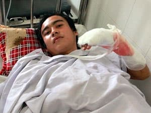 Nối tay thành công cho nạn nhân bị cá sấu cắn