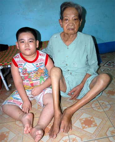 Bà thì suy thận, cháu bị bại não