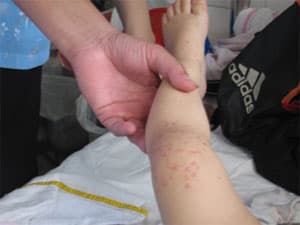 Bệnh sốt xuất huyết và tay chân miệng chưa hạ nhiệt