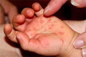 Theo dõi chặt chẽ virus EV71 gây bệnh tay - chân - miệng