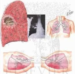 Mùa đông với nỗi lo bệnh áp-xe phổi