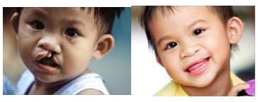 Phẫu thuật miễn phí cho trẻ em hở môi và hàm ếch