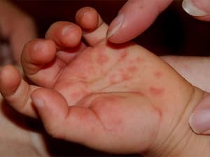 Chủng virus EV71 nguy hiểm ở tỉnh Quảng Ngãi