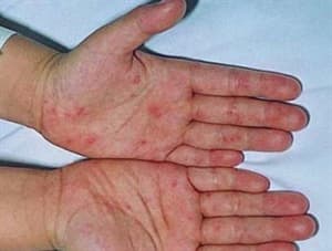 Tăng cường các biện pháp phòng, chống bệnh tay chân miệng