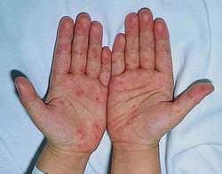 Đồng Nai đứng thứ hai về số ca mắc dịch tay chân miệng