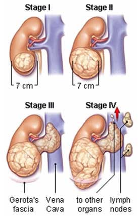 Chất độc da cam/đi-ô-xin có liên quan tới ung thư thận
