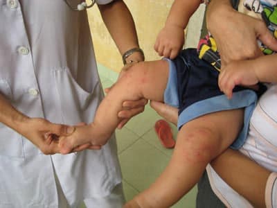 Tăng cường các biện pháp phòng, chống bệnh tay chân miệng