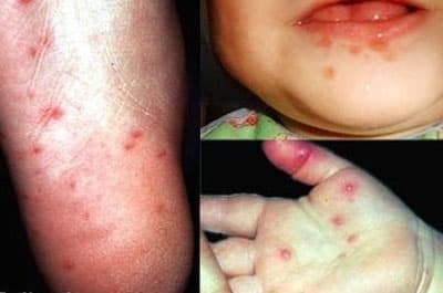 Cả nước đã ghi nhận 35.623 ca mắc bệnh tay chân miệng