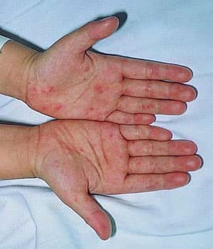 Phát hiện chủng virus mới gây bệnh tay chân miệng