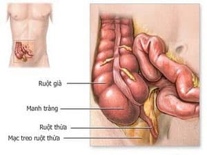 Viêm ruột thừa, cần phẫu thuật hay không?