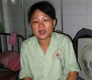 Tái tạo thành công khớp thái dương hàm sau phẫu thuật cứng khớp bằng kỹ thuật cân cơ