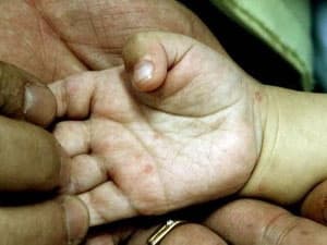 Bệnh tay chân miệng tăng đột biến tại tỉnh Đồng Nai