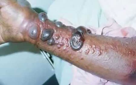 Nigeria ghi nhận trường hợp thứ 2 nhiễm virus Ebola