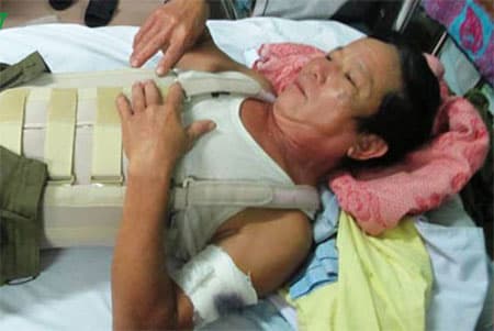 Rượt đuổi "cẩu tặc", bị chém nhập viện