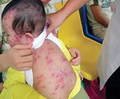 Phòng bệnh sởi, không có cách nào hiệu quả hơn tiêm phòng