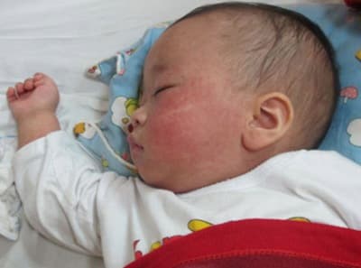 Dịch sởi nhiễm chéo phức tạp, số nhiễm mới đang giảm
