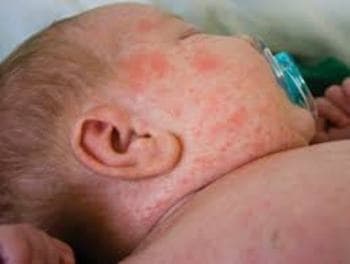 Các trường hợp tử vong liên quan đến sởi chủ yếu do viêm phổi ở trẻ nhỏ