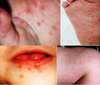 Đã có 2 ca tử vong do bệnh tay chân miệng