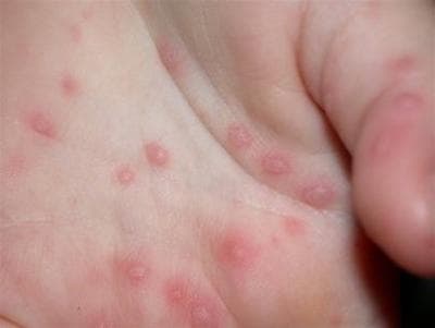 Thành lập 5 đoàn kiểm tra bệnh tay chân miệng