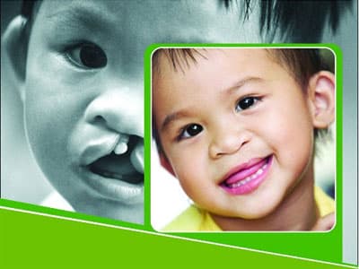 Sẽ phẫu thuật miễn phí cho 50 trẻ em trong tháng 11