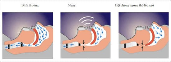 Ngưng thở khi ngủ - một tình trạng sức khỏe nguy hiểm