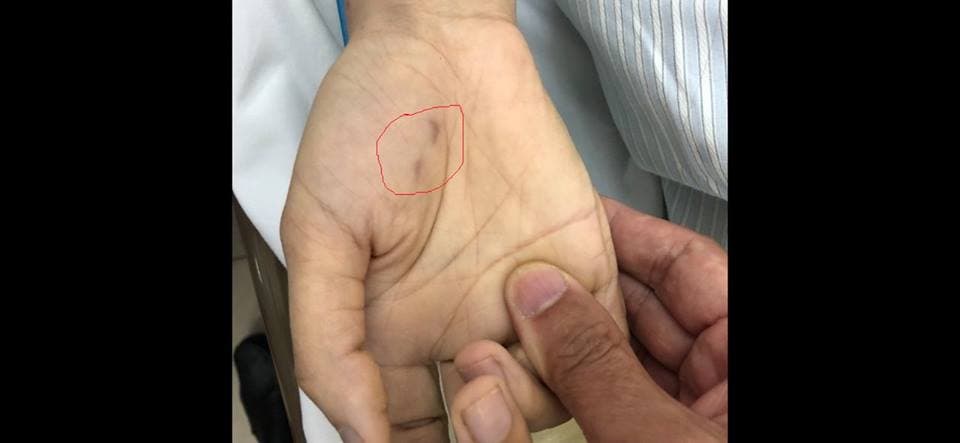 Chủ quan không tiêm phòng, một bệnh nhân tử vong do bệnh dại
