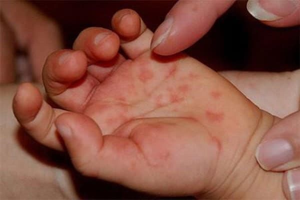 Bộ Y tế yêu cầu khẩn trương chống dịch bệnh tay chân tay miệng