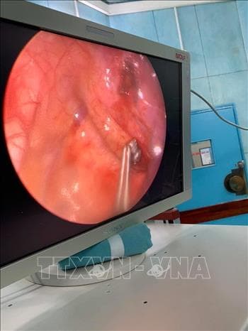 Phẫu thuật nội soi lấy viên đạn ra khỏi lồng ngực bé trai 6 tuổi