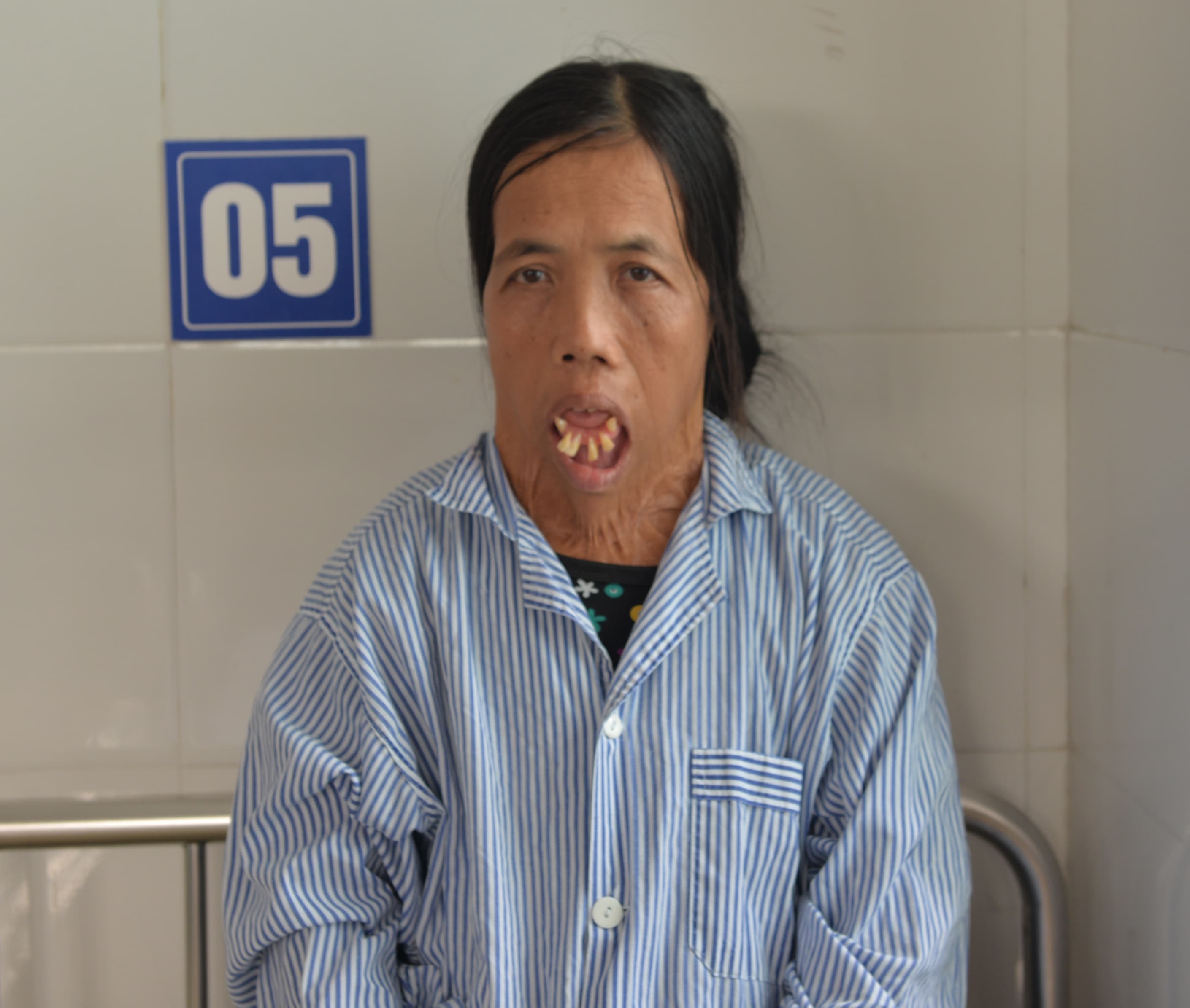 Bệnh viện Bỏng Quốc gia phẫu thuật thành công cho bệnh nhân 48 năm không ngậm được miệng