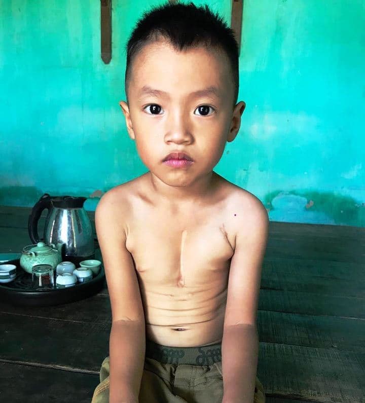 Cháu bé bệnh tim bẩm sinh cần giúp đỡ