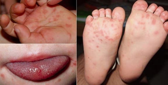 Bệnh tay chân miệng bùng phát trở lại tại Lâm Đồng