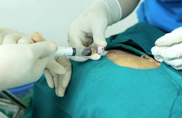 Những lưu ý sau khi hút mỡ