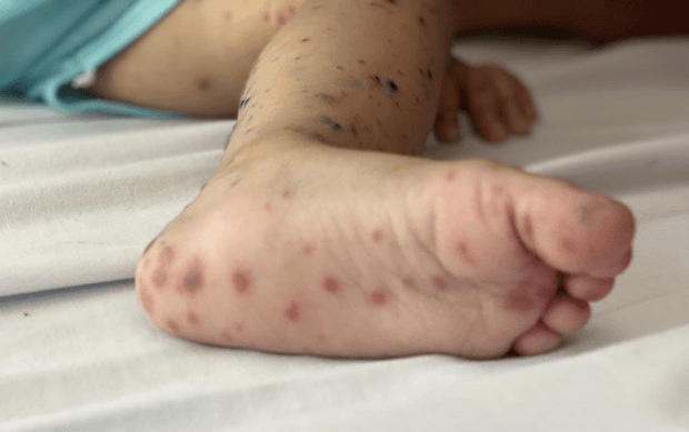 Người lớn không nên chủ quan với bệnh tay chân miệng