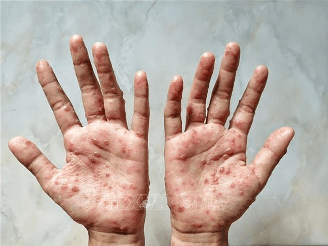 6 giải pháp phòng, chống dịch bệnh đậu mùa khỉ