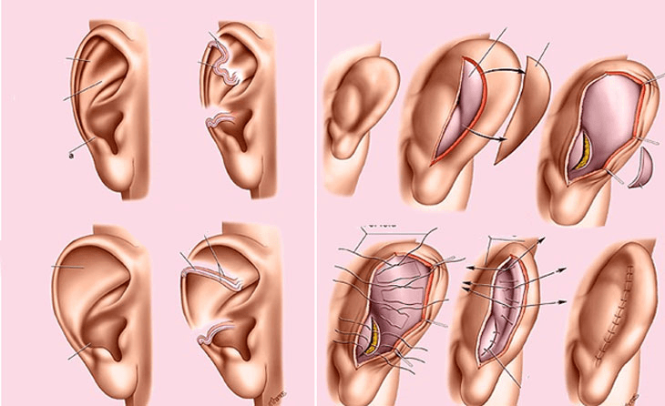 Bác sĩ của bạn: Nên đến cơ sở y tế uy tín để khắc phục dị tật vành tai