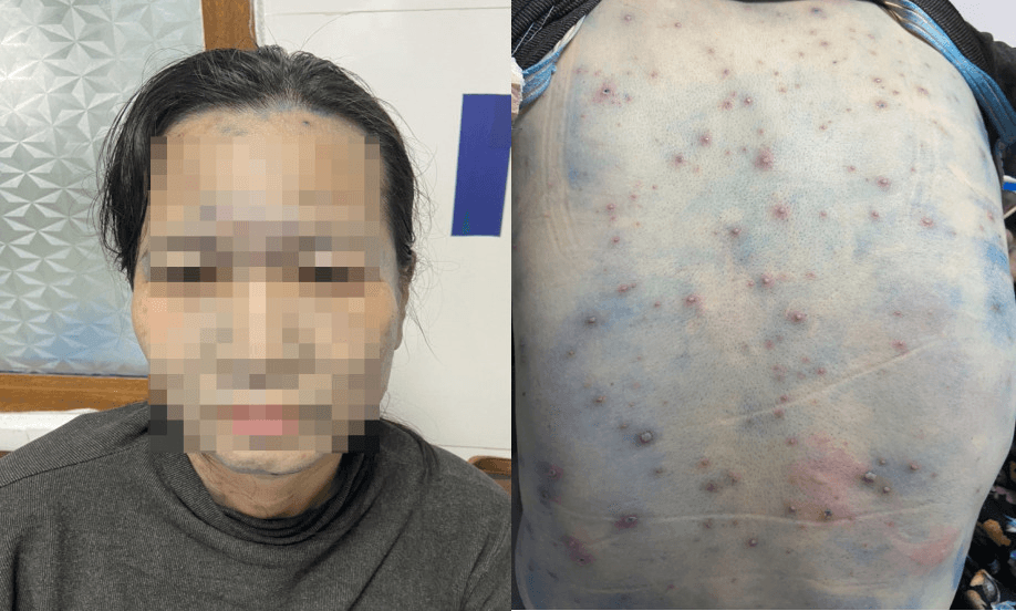 Bệnh nhân mắc thủy đậu có bệnh nền dễ bị biến chứng