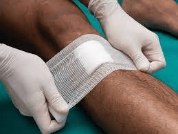 Không tự ý điều trị vết thương hở bằng phương pháp dân gian