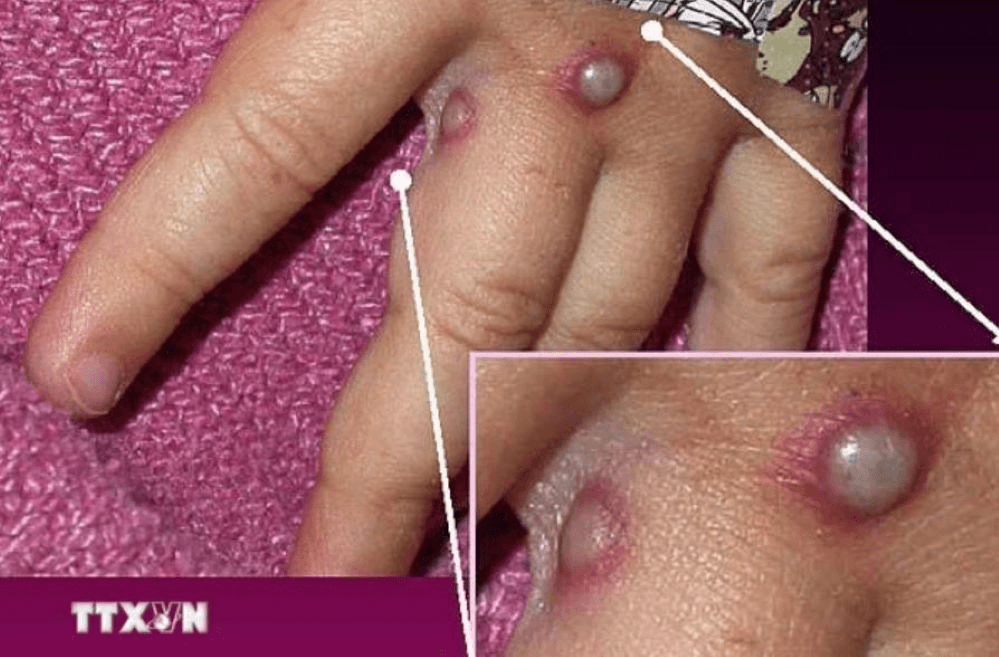 WHO sẽ họp khẩn để đánh giá về bệnh đậu mùa khỉ