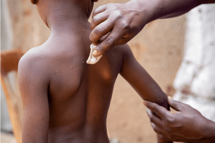 UNICEF phát hành gói thầu khẩn cấp để đảm bảo việc cung cấp vaccine phòng bệnh đậu mùa khỉ