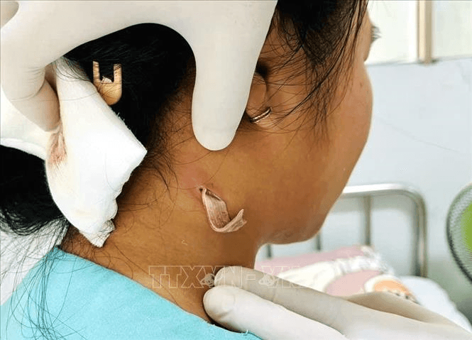 Đồng Nai ghi nhận ca bệnh từ vi khuẩn Whitmore đầu tiên

​