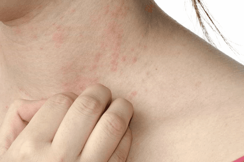 Thủ tướng yêu cầu tăng cường công tác phòng, chống bệnh sởi