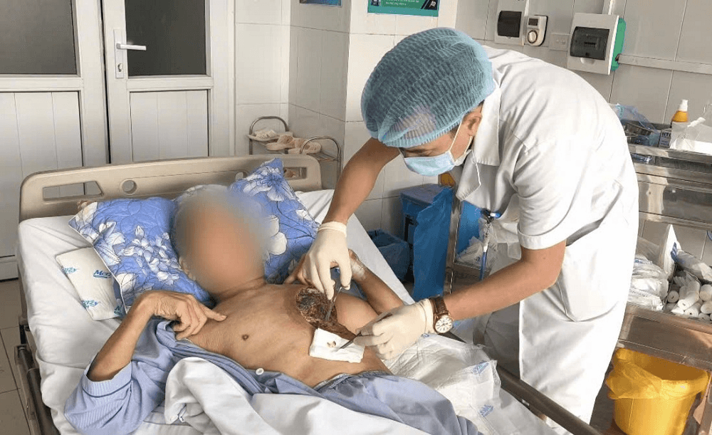 Hoại tử vùng ngực do nhiễm nấm hiếm gặp