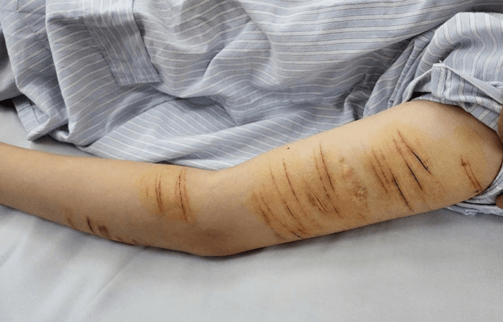 Tự gây thương tích cho bản thân vì stress