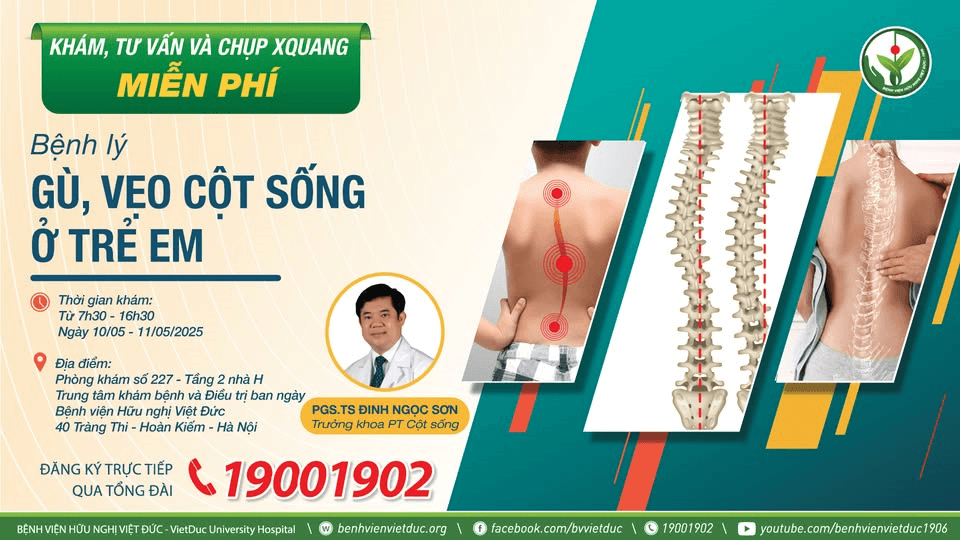 Bệnh viện Hữu nghị Việt Đức khám và tư vấn miễn phí cho trẻ em mắc gù vẹo cột sống