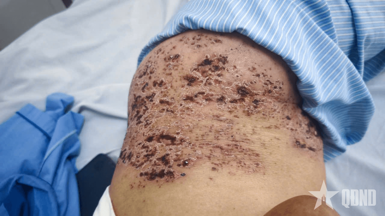 Zona thần kinh sẽ biến chứng nặng nếu không được điều trị kịp thời