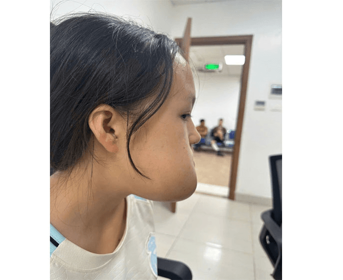 Phẫu thuật loại bỏ khối u lớn trên mặt